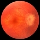 Optic Nerve Head Drusen