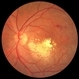 Branch Retinal Vein Occlusion with Diffuse Lipid Exudate Branch Retinal Vein Occlusion with Diffuse Lipid Exudate