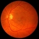 Retinoschisis/Retinal Detachment Retinoschisis/Retinal Detachment