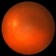 Retinoschisis/Retinal Detachment Retinoschisis/Retinal Detachment