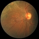 Choroidal Nevus Progressed to Melanoma Choroidal Nevus Progressed to Melanoma