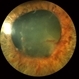 Rubeosis and Fibrin Rubeosis and Fibrin