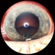 Traumatic Dislocated Crystalline Lens Traumatic Dislocated Crystalline Lens