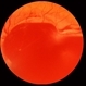 Acute Subhyaloid Hemorrhage CF Acute Subhyaloid Hemorrhage CF