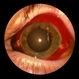 Subconjunctival Hemorrhage Subconjunctival Hemorrhage
