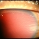 Hyphema, Total Hyphema, Total