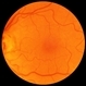 Macular Hole Post-Op Macular Hole Post-Op