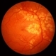 Purtscher's Retinopathy with Diffuse Cotton Wool Spots CF Purtscher's Retinopathy with Diffuse Cotton Wool Spots CF