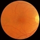 Macular Hole