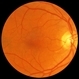 Macular Hole Post-Op Macular Hole Post-Op
