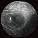 Central Serous Chorioretinopathy with Smokestack FA Early Phase Central Serous Chorioretinopathy with Smokestack FA Early Phase