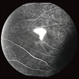 Central Serous Chorioretinopathy with Smokestack Late Phase Central Serous Chorioretinopathy with Smokestack Late Phase