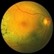 Sector Retinitis Pigmentosa Sector Retinitis Pigmentosa