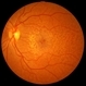 Reticular Drusen Reticular Drusen
