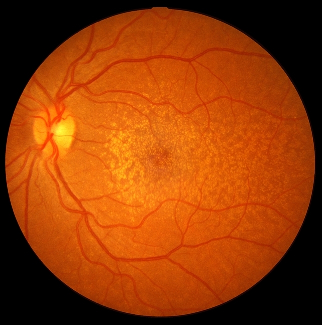 Reticular Drusen - Retina Image Bank