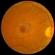 Macular Hole Macular Hole