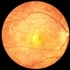 Rubella Retinopathy Rubella Retinopathy