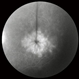 Cystoid Macular Edema Cystoid Macular Edema