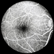 Normal FA Early Phase Normal FA Early Phase