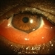 Chemosis Chemosis