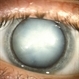 Hypermature Cataract Hypermature Cataract