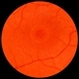 Macular Hole Macular Hole