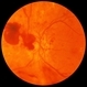 PDR with Active NVD PDR with Active NVD