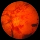 PDR with Active NVD PDR with Active NVD