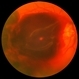PDR with Severe Subhyaloid Hemorrhage PDR with Severe Subhyaloid Hemorrhage