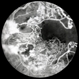 PDR with Severe Macular Ischemia PDR with Severe Macular Ischemia