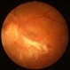 PDR with Traction RD of Macular PDR with Traction RD of Macular