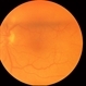 Macular Hole Stage 3 Macular Hole Stage 3