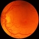 Macular Hole Macular Hole