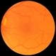 Macular Hole Post-Op Macular Hole Post-Op