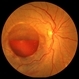 Subhyaloid Hemorrhage Subhyaloid Hemorrhage