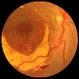 Subhyaloid Hemorrhage Subhyaloid Hemorrhage