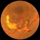 Reabsorbing Subretinal Hemorrhage Reabsorbing Subretinal Hemorrhage