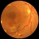Arteriolar  Macroaneurysm Arteriolar  Macroaneurysm