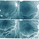 Arteriolar Macroaneurysm Arteriolar Macroaneurysm