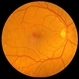 Juxtafoveal Hemorrhage, Partially Reabsorbed Juxtafoveal Hemorrhage, Partially Reabsorbed
