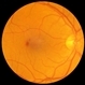 Juxtafoveal Hemorrhage with Recurrence Juxtafoveal Hemorrhage with Recurrence