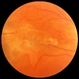 Macular Pucker Macular Pucker