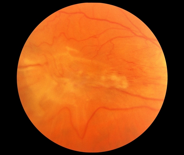 Oct Image Of Macular Pucker