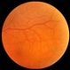 Choroidal Folds Choroidal Folds