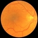 Macular Pucker Pre-Op Macular Pucker Pre-Op