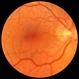 Macular Pucker Post-Op Macular Pucker Post-Op