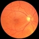 Macular Pucker Pre-Op Macular Pucker Pre-Op