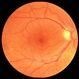 Macular Pucker Post-Op Macular Pucker Post-Op