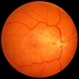 Macular Pucker Pre-Op Macular Pucker Pre-Op