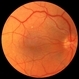 Macular Pucker Post-Op Macular Pucker Post-Op